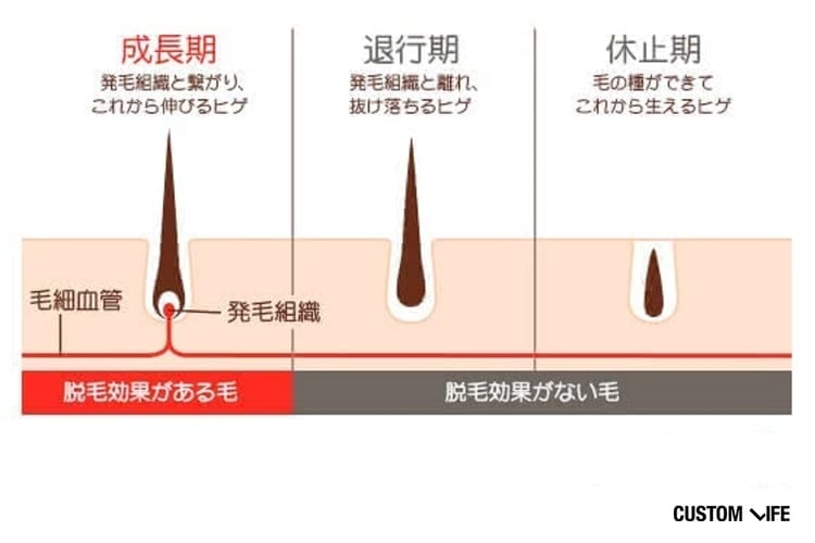 ヒゲ脱毛,効果