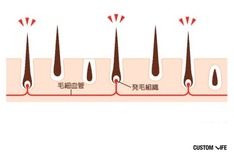 ヒゲ脱毛,効果