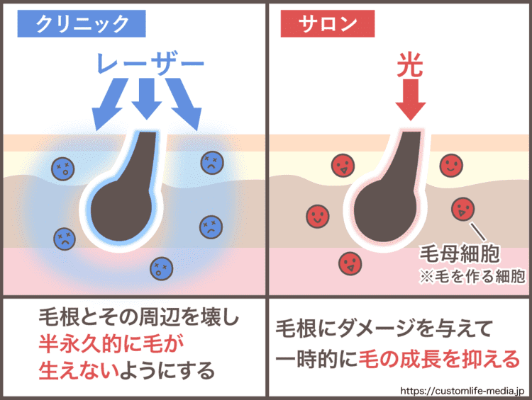 クリニックとサロンの脱毛方法の違い