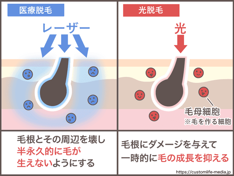 医療脱毛は毛根とその周辺、光脱毛は毛根にのみ働きかけます