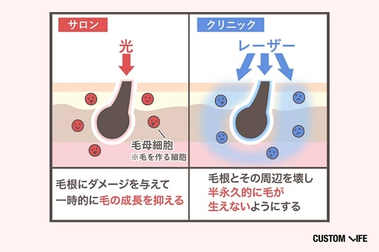 サロンとクリニックの脱毛方法の違い