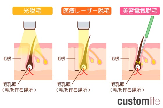 口ヒゲ脱毛,おすすめ