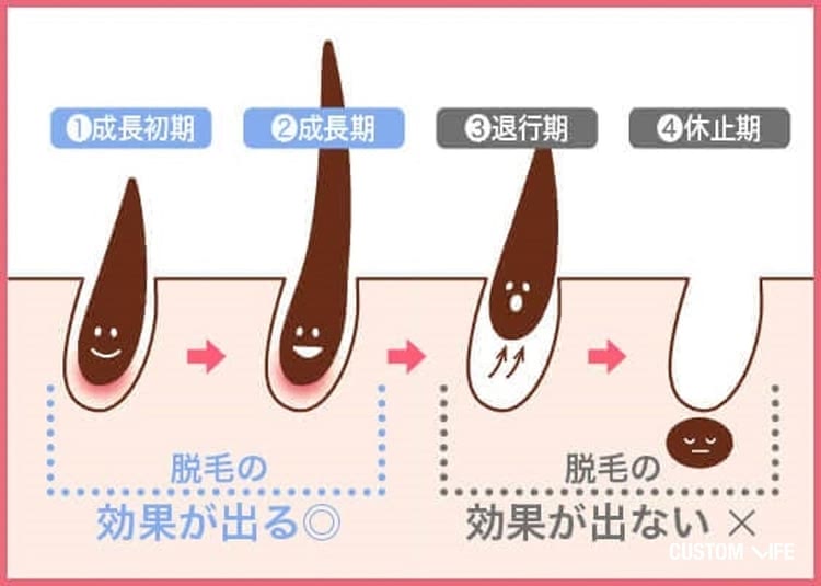 成長初期と成長期なら脱毛の効果は出るが、退行期と休止期は脱毛の効果が出ない