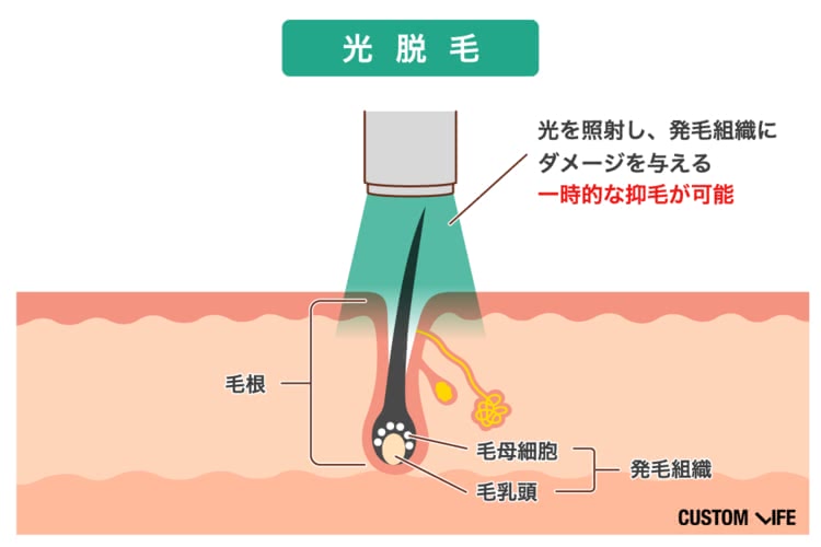 ヒゲ脱毛,費用