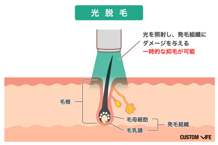 ヒゲ脱毛体験