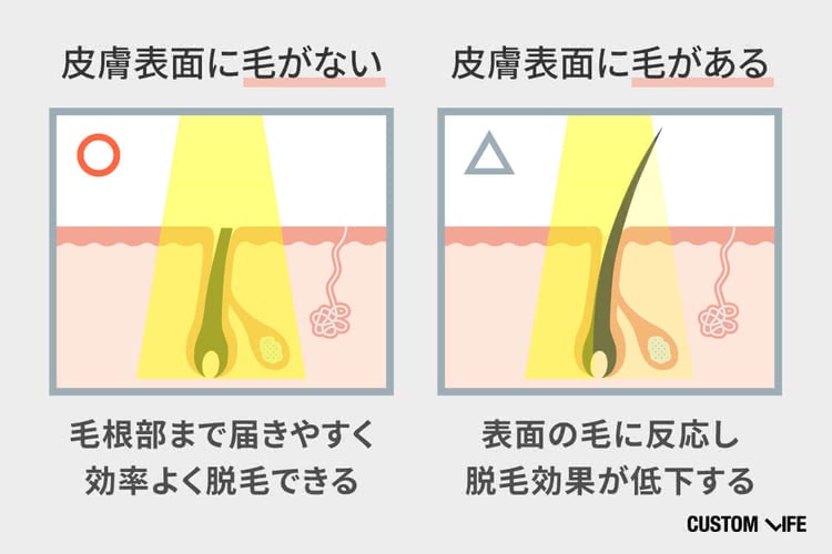 すね毛,脱毛