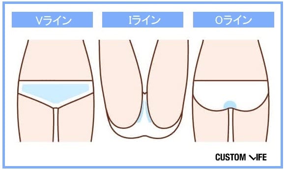 Vライン、Iライン、Oラインの施術範囲