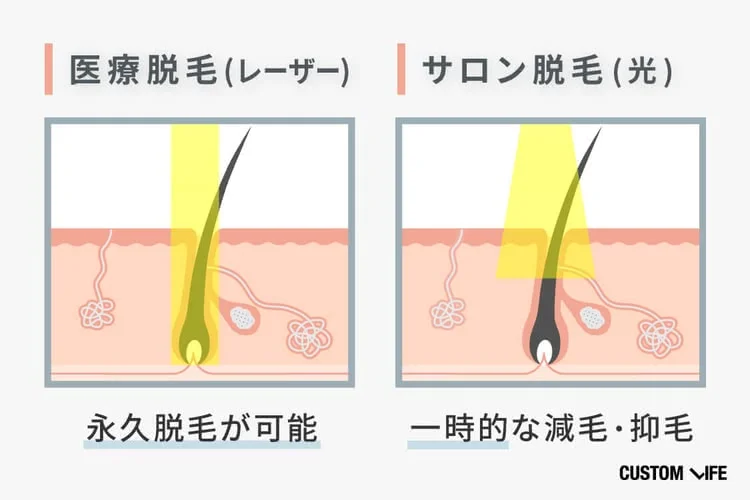 メンズ医療脱毛,おすすめ