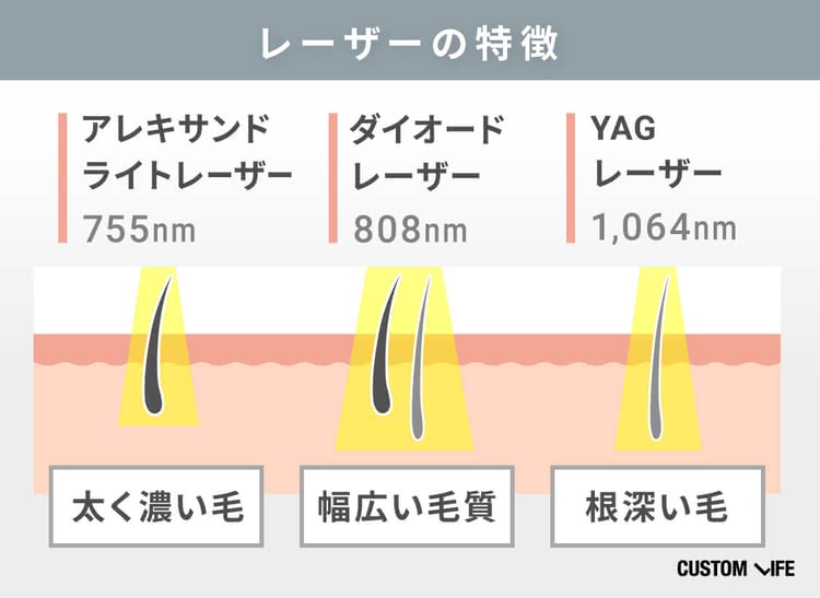 すね毛,脱毛