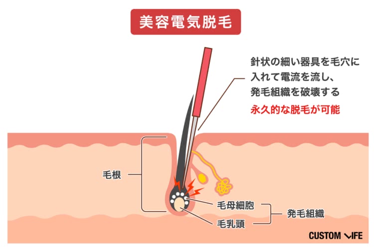 ヒゲ脱毛,費用