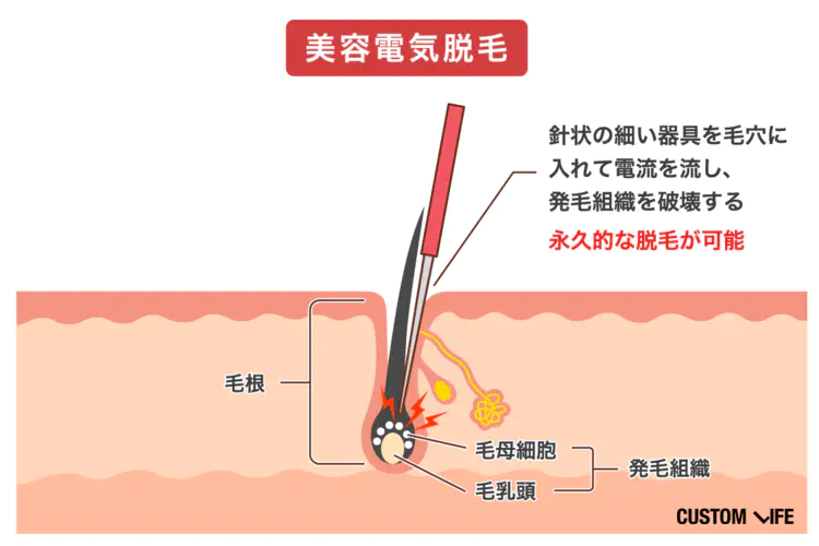 ヒゲ脱毛体験