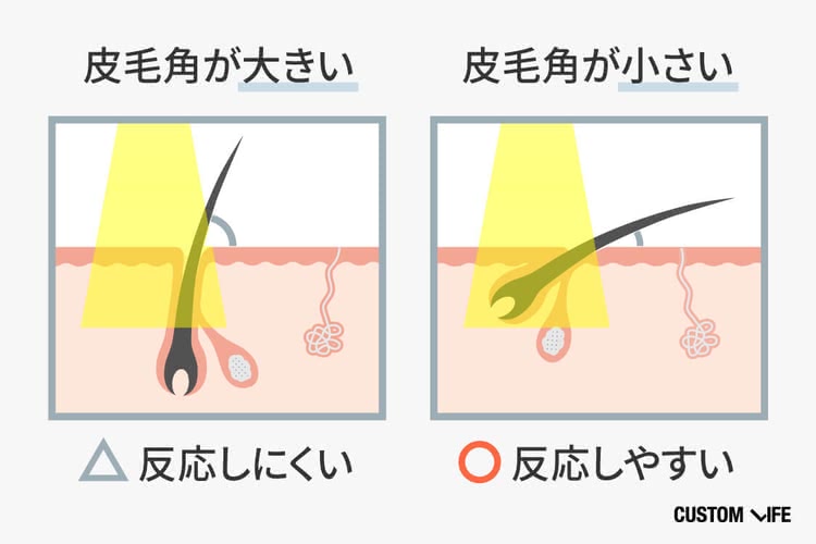 すね毛,脱毛