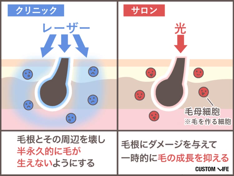 クリニックとサロンの脱毛方法・効果の違い