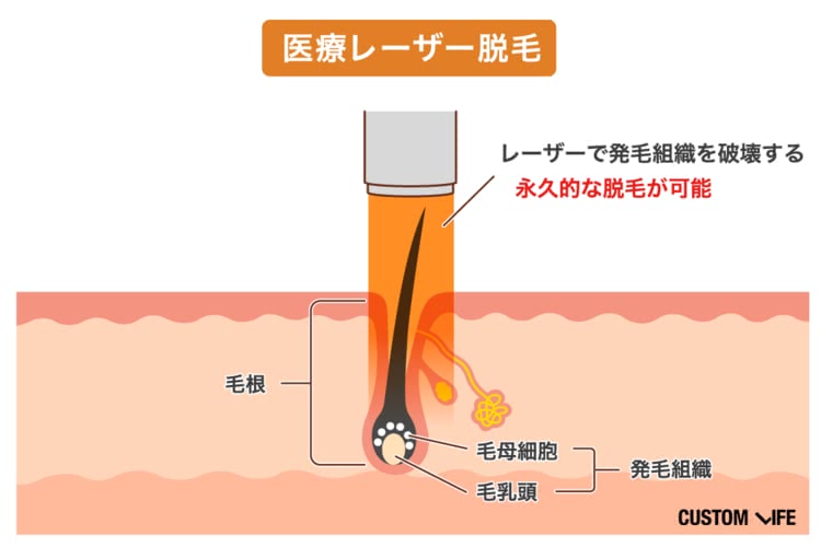 ヒゲ脱毛,費用