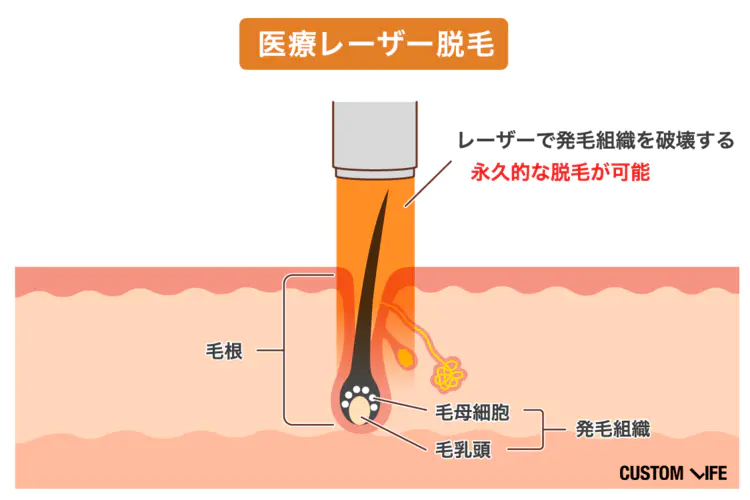 ヒゲ脱毛体験